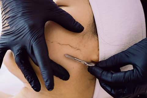 Dermaplaning